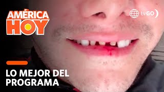 América Hoy: Carlos Cacho perdió varios dientes tras ser atropellado por una moto  (HOY)