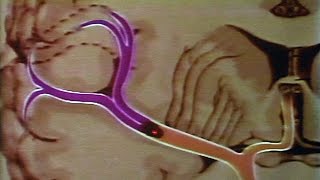 Advances in the Treatment and Diagnosis of Acute Stroke: What You Need to Know