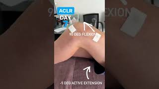 New ACL surgery patient in this week. Here is his active ROM at day 7 post-op.