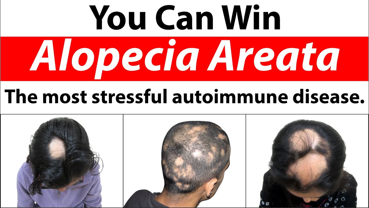 You Can Win Alopecia Areata With 100% Natural Treatments At Dr. Rohit's ...