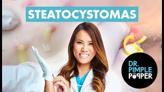 60 Minutes of Steatocystomas That Altered My Brain Chemistry