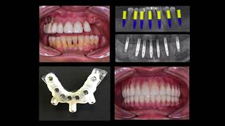 Computer-Guided Dental Implants from Dr. Nazarian