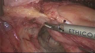 Asvide: Laparoscopic modify extralevator abdominoperineal resection