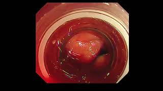 Utility of RDI for identifying bleeding point in endoscopic hemostasis of CDB