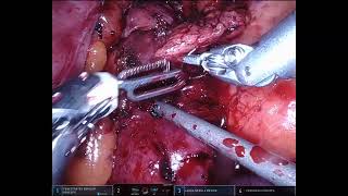 Asvide: A novel approach of robotic uncinate enucleation with transmesenteric sleeve duodenectomy...