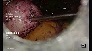 lap adenomyomectomy