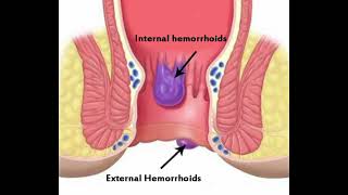 What is hemorrhoids and  types of hemorrhoids l internal and external l