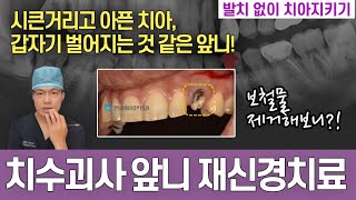 갑자기 벌어지는 것 같은 앞니! 시큰거리고 아프기까지? 발치가 답일까? 앞니재신경치료, 실활치미백으로 발치 없이 치아지키기! (자연스럽고 티 안나는 앞니치료)