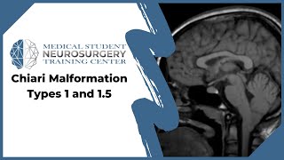 Chiari Malformation Types 1 and 1.5