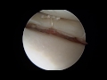 all inside all suture medial and lateral meniscus repair using ceterix novostitch