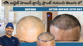 Hair Transplant In Hyderabad | Best Center Results & Cost Of Hair Transplant Surgery In Hyderabad