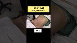 টামি টাক সার্জারির ফলাফল | Tummy tuck surgery result | Dr Iqbal Ahmed | Bangladesh cosmetic surgery