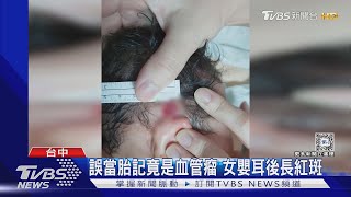 誤當胎記竟是血管瘤 女嬰耳後長紅斑｜TVBS新聞 @TVBSNEWS01