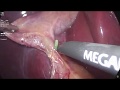 Laparoscopic Cholecystectomy - CVS Demo - By Dr. Ahmad Al-Shabasy