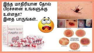 LYME DISEASE-இந்த ஆபத்தான பூச்சிக்கடிக்கு இனி இதை பயன்படுத்துங்கள் ...