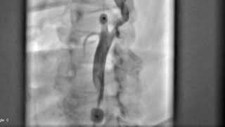 Ulcerated Carotid Stenosis treated with CGuard™, Prof. Musialek