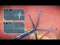 Cardiac Electrophysiology Systems | Trailer | Biomedical Engineers TV |