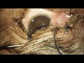 Pterygium excision with conjunctival rotation graft