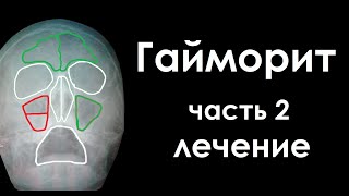 Гайморит - моя болезнь, лечение