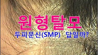 원형탈모에 두피문신(SMP) 5개월 후 눈물흘린다.