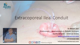 Extracorporeal Ileal Conduit after Robotic / Laparoscopic Radical Cystectomyt