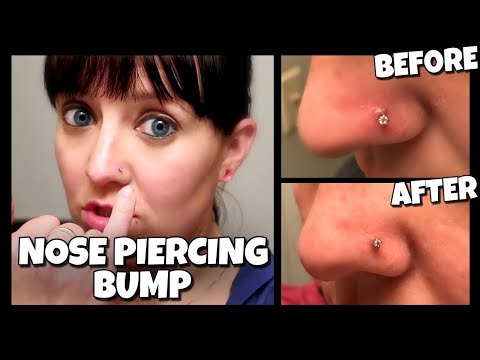 How To Get Rid Of A Nose Piercing Bump FAST! | (Keloid) | I Am Kristin📍 How To Get Rid Of A Nose Piercing Bump FAST! | (Keloid) | I Am Kristin📍