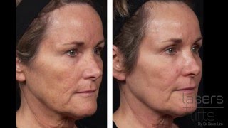 How long does it take to heal from CO2 laser resurfacing? (Fractional)