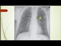 Histoplasmosis a clinical case based review, geography, symptoms, differential diagnosis, treatment