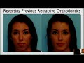 can orthodontic retraction be reversed