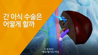 간 이식 수술은 어떻게 할까 - (20140423_500회 방송)_500회 특집 [코리안 닥터스 1부] 세계 중심에 서다