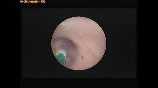 Difficult ETV with Aqueductoplasty