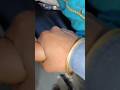 cannulation.. video.. part 520 #shorts #viral