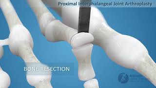Hammertoe PIPJ Arthroplasty Treatment