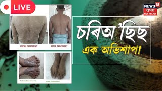 Psoriasis ৰ বিষয়ে সবিশেষ Live | ছালৰ কি এই ভয়ংকৰ ৰোগ | ডাক্তৰী পৰামৰ্শ Assam News | News18 Assam NE