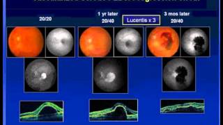 Clinical Value of ICG Angiography in Eyes that Fail anti-VEGF Therapy