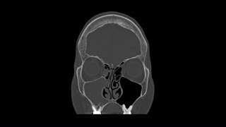 Maxillary Odontogenic Sinusitis