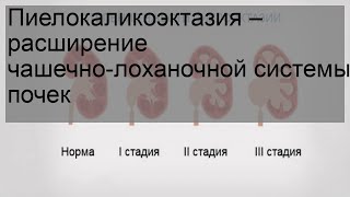 Пиелокаликоэктазия – расширение чашечно-лоханочной системы почек