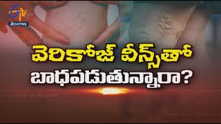 Treatment for Varicose veins | Sukhibhava | 9th June 2022 |  ETV Telangana