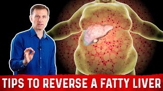 4 Critical Tips to Reverse a Fatty Liver – Dr. Berg