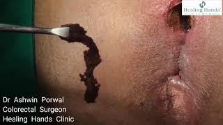 Complex recurrent Ano Scrotal Fistula with 3 branches cured by Dr Ashwin Porwal DLPL Laser surgery