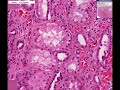 histopathology kidney arteriolosclerosis hypertension an