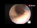 some basic operations under otoendoscopy