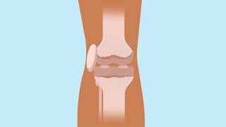 How knee replacement surgery is carried out