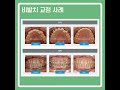 교정 후 얼마나 달라지는지 궁금하시죠 치아 교정 사례를 보여드리겠습니다