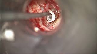 Ossiculoplasty for incudostapedial erosion using Otomimix