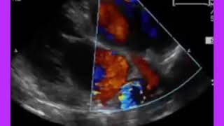 Muscular Ventricular Septal Defect (VSD)