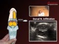 ULTRASOUND GUIDED DORSAL PENILE NERVE BLOCK