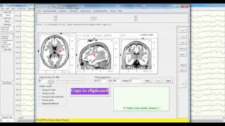 LORETA Time Domain Capture