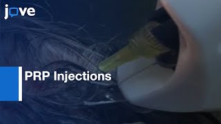 PRP Injections for (AGA) Androgenetic Alopecia | Protocol Preview