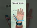 Trigger Thumb #triggered #shorts #innovation #movement #physicaltherapy #anatomy